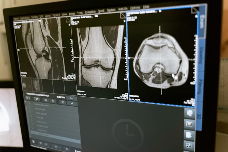 எலும்புப் புற்றுநோய் (Osteosarcoma)