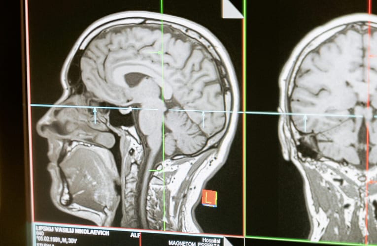 அமிலத்தன்மை-செயல்படுத்தக்கூடிய டைனமிக் நானோ துகள்கள் மூலம் புற்றுநோய் நோயெதிர்ப்பு சிகிச்சை