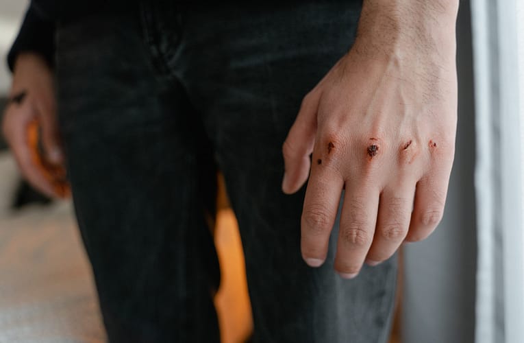 சிரங்கு (Impetigo)