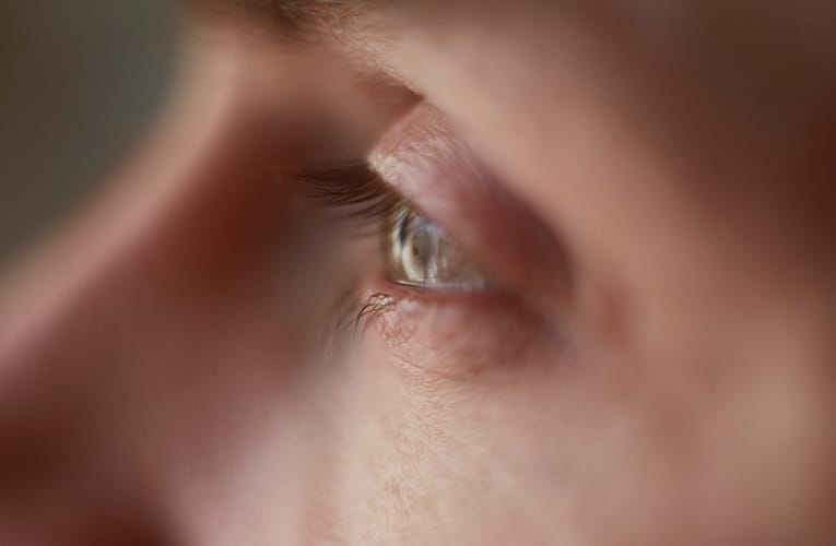 கண்புரை (Cataract)