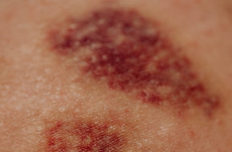 நாள அழற்சி (Vasculitis)