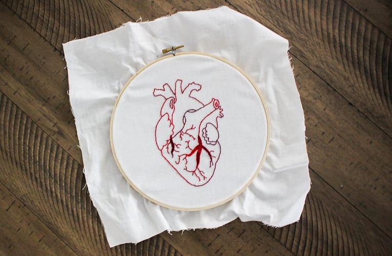 இதயத் தசை நோய் (Cardiomyopathy)