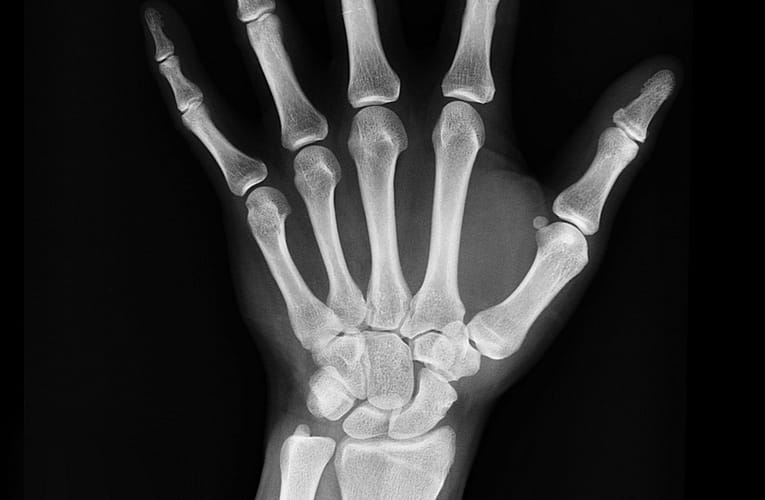 எலும்புப்புரை (Osteoporosis)