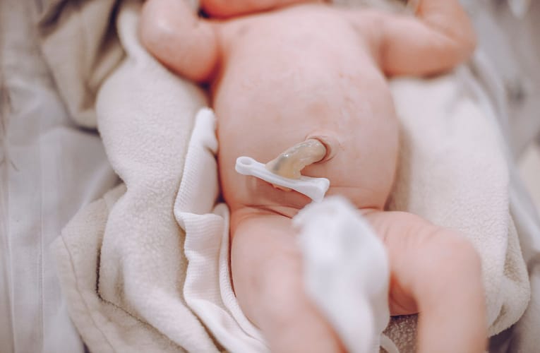 தொப்புள் குடலிறக்கம் (Umbilical hernia)