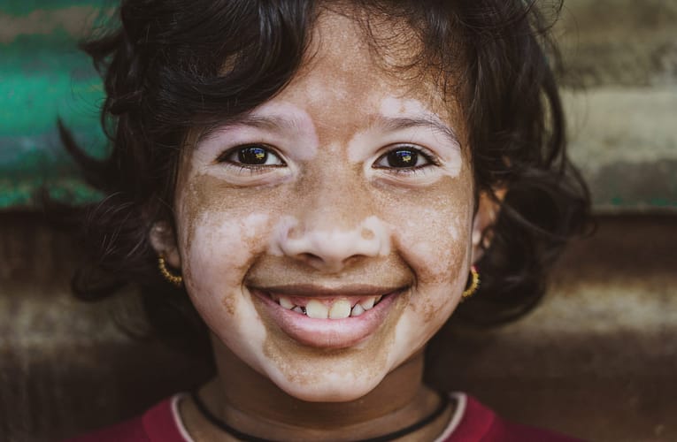 தோல் நிறமி இழத்தல் (Vitiligo)