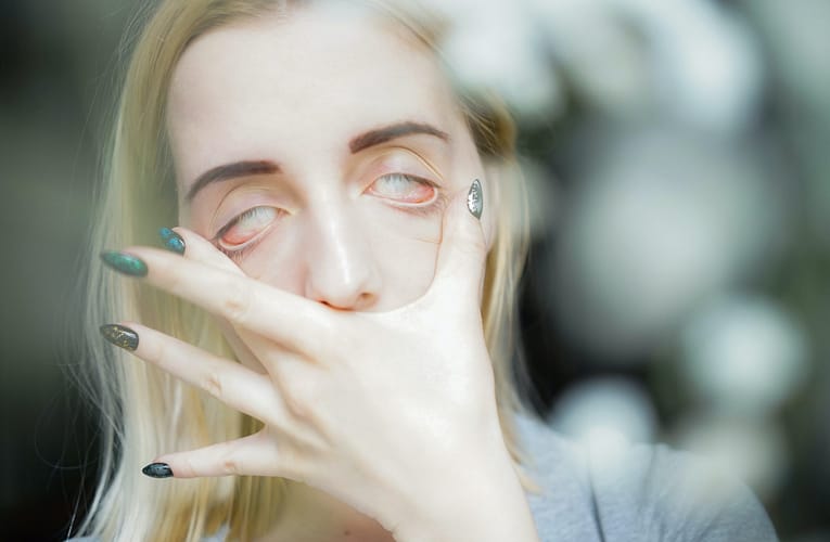 செந்நிற கண் (Red eye)