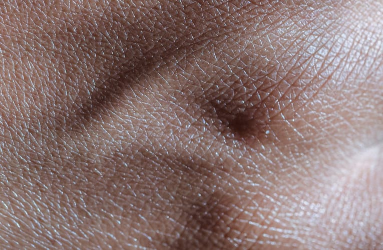 பிறப்புறுப்பு மருக்கள் (Genital Warts)