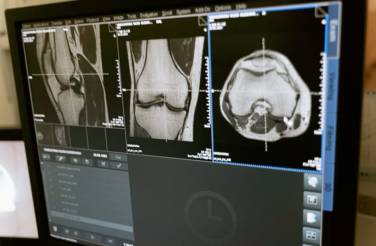 எலும்புப் புற்றுநோய் (Osteosarcoma)