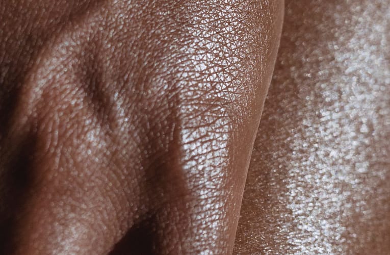 அரிப்பு தோலழற்சி (Neurodermatitis)