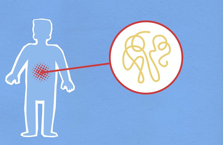 கணைய அழற்சி (Pancreatitis)