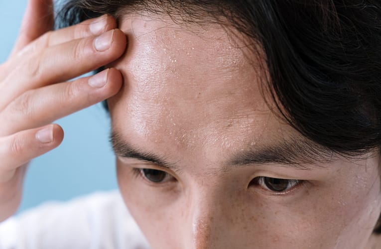 வியர்வைக்கட்டி (Dyshidrosis)