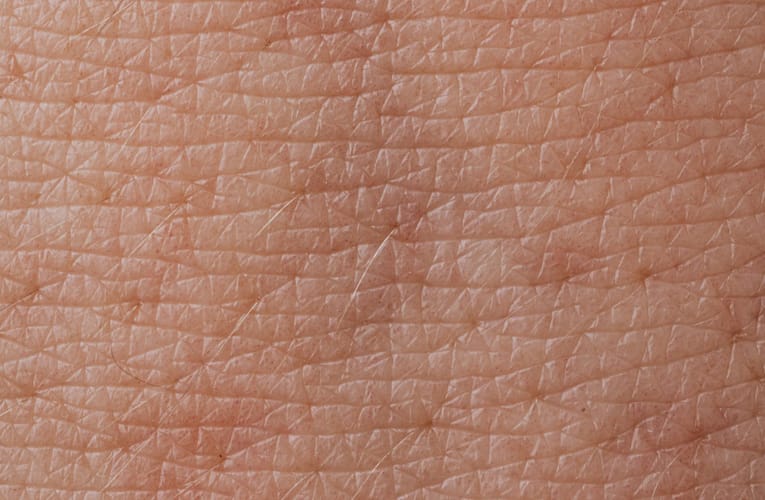 அகாந்தோசிஸ் நிக்ரிகன்ஸ் (Acanthosis nigricans)