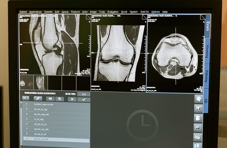 எலும்பு புற்றுநோய் (Bone Cancer)