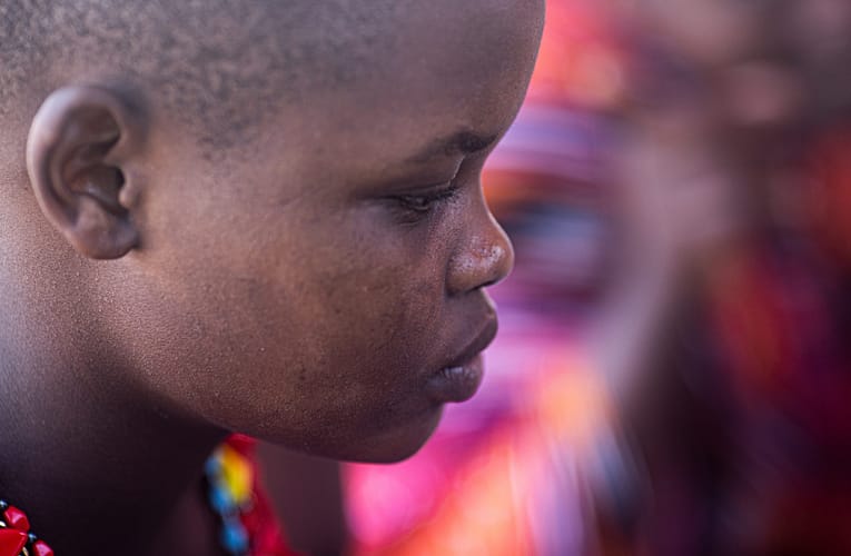 ஊறல் தோலழற்சி (Seborrheic dermatitis)