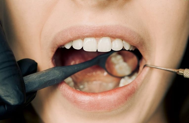 பாதிக்கப்பட்ட ஞானப் பற்கள் (Impacted wisdom teeth)