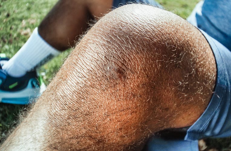 சிரங்கு (Scabies)