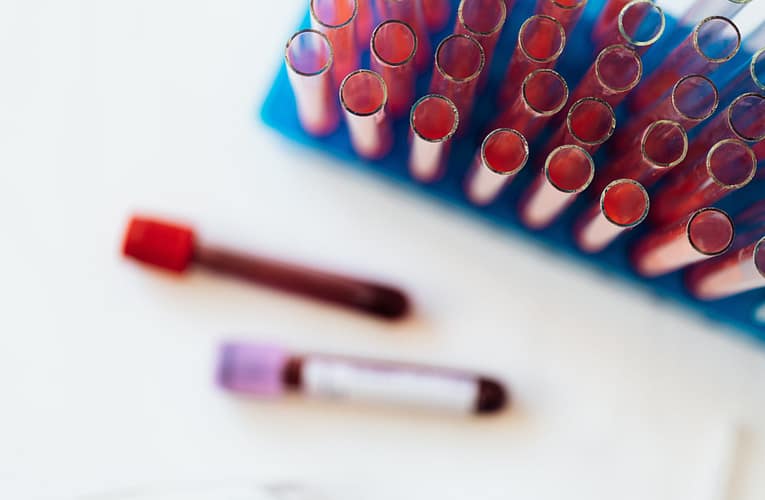 இம்யூன் த்ரோம்போசைட்டோபீனியா (Immune Thrombocytopenia – ITP)