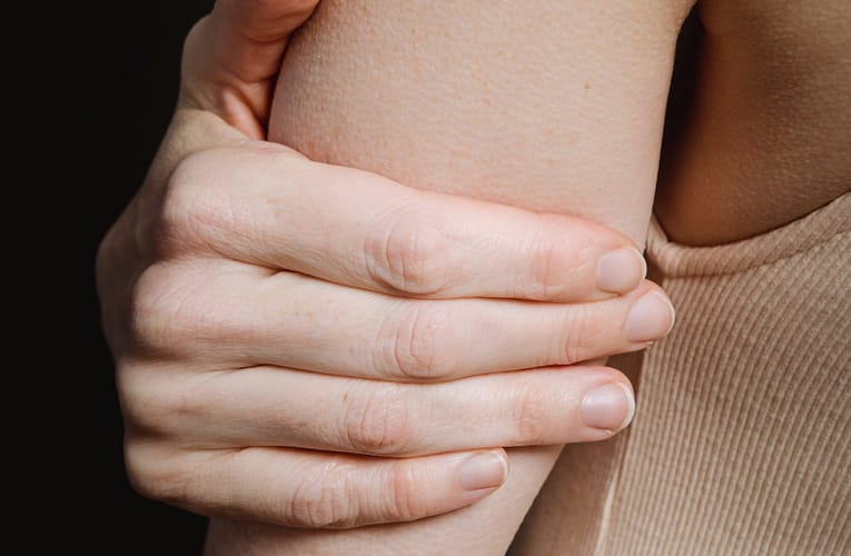 அரிக்கும் தோலழற்சி (Atopic dermatitis – Eczema)