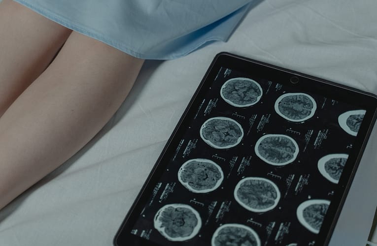 கிருட்ஸெஃபெல்ட்-ஜாகோப் நோய் (Creutzfeldt-Jakob Disease)